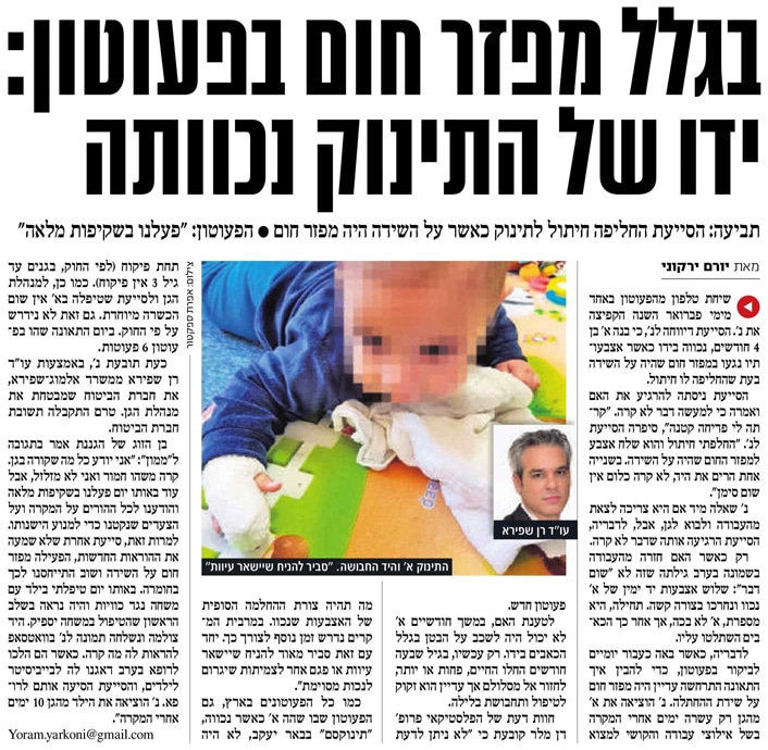 כוויית יד של קטין